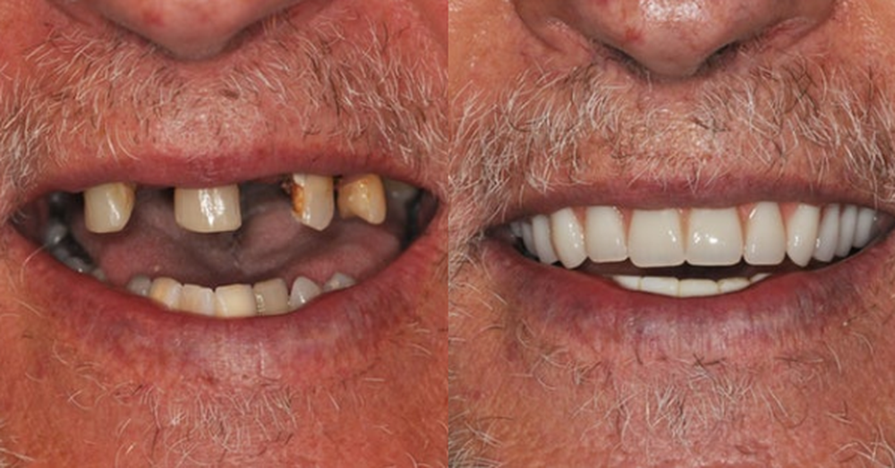 Before and After Dental Implant